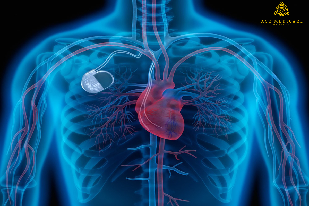 All You Need to Know About Pacemaker Surgery: Common Questions and Answers